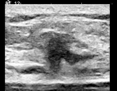 Follicular neoplasm of the thyroid on ultrasound