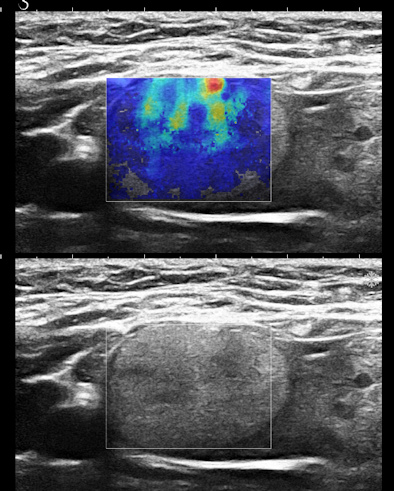 8-mm nodule in parenchyma on ultrasound