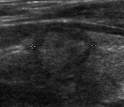 Transverse ultrasound of thyroid cancer
