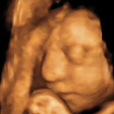 3D ultrasound at 30 weeks in woman with Zika