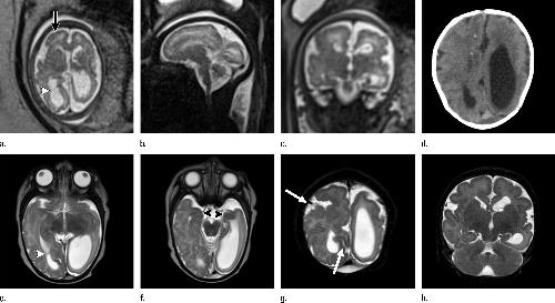 MRI of fetus in woman with Zika