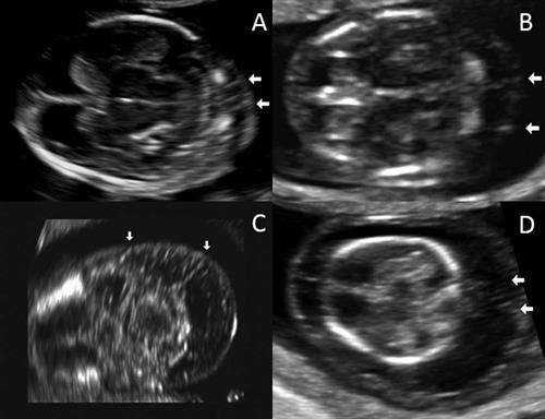 Ultrasound images of nuchal septations in a transverse plane