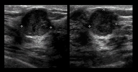 ultrasound image left breast cancer