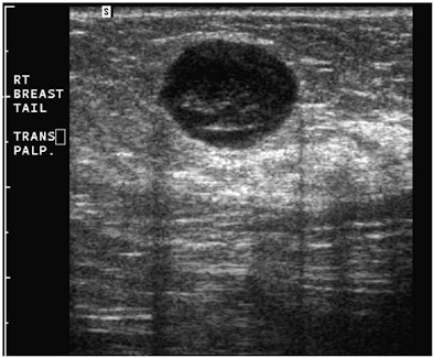 Ultrasound of circumscribed round pseudocystic mass