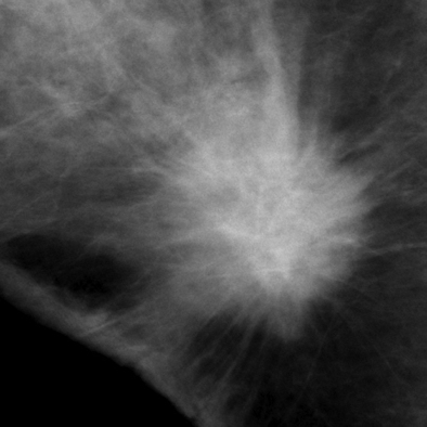Mammography shows spiculated lesion
