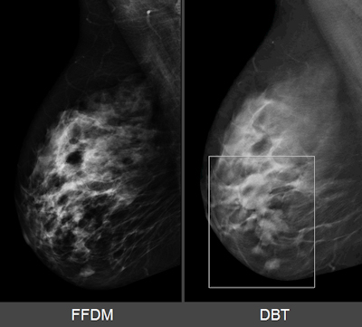 SenoClaire 3D mammography