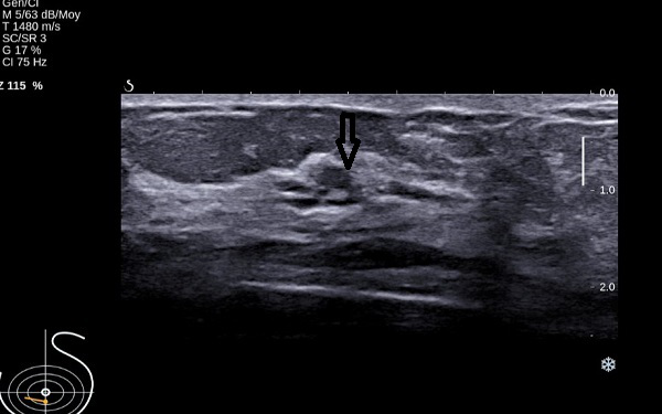 Second-look ultrasound demonstrates three ducts of normal caliber in correlation