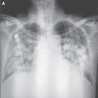 X-ray, CT uncover novel coronavirus-infected pneumonia